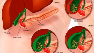 GASTROENTEROLOGIE  angiocholite pancréatite aigue cholécystite aigue colique hépatique [upl. by Waring]