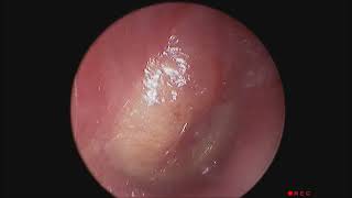 An Established Acute Otitis Media Causing Ear Pain And Reduced Hearing [upl. by Namdor290]