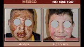 Cirugías Plásticas México  Lesiones por Quemaduras y Trauma Facial [upl. by Nedry697]