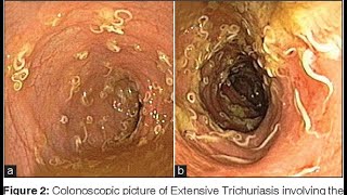 Trichuris Trichura  Trichuriasis  Morphology  Life Cycle Pathogenesis  Treatment  Microbiology [upl. by Stavros]