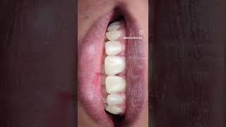 Midline Diastema Clouser by DrJaydip sakariya [upl. by Sheryle]