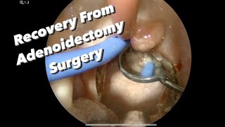 Post Op Adenoidectomy how much pain what not to eat what activities to avoid when is post op [upl. by Iaverne]