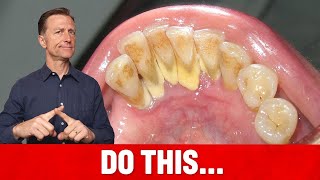 The 1 Top Remedy for Dental Plaque TARTAR [upl. by Stine]