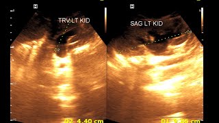 Bilateral hydro nephrosis  Bilateral dilated ureter  Renal Ultrasonography [upl. by Rhines89]