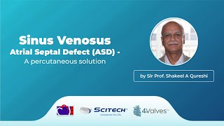 Sinus Venosus Atrial Septal Defect ASD  A percutaneous solution by Shakeel Qureshi [upl. by Rikahs130]