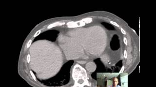 CT Abdomen and Pelvis ANATOMY Discussion by Radiologist [upl. by Natsirk479]