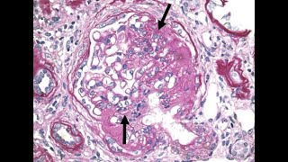 Nephrotic Syndrome Made Easy Causes Pathology Diagnosis Management [upl. by Loella]