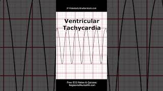 ECG EKG Heart Rhythms POP Quiz Can You Identify These Heart Rhythms shorts ecg nursing [upl. by Sanferd362]