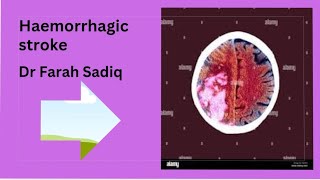 haemorrhagic  stroke  subarachnoid hemorrhage subdural extradural hematoma [upl. by Eruza680]