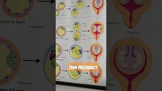 dizygotic and monozygotic definition for TWINS Pregnancy 😳😍 [upl. by Kirkpatrick834]