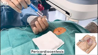 Pericardiocentesis [upl. by Conti]