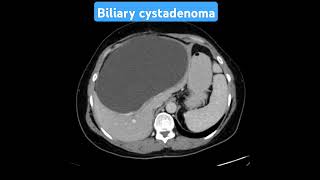 CT scan case 78 Biliary cystadenoma ctscan radiology radiologist mri abdominalradiology [upl. by Urbas]