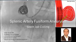 Splenic artery aneurysm stent jail coiling [upl. by Thatcher]