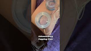 Cupping Therapy functional [upl. by Steffi]