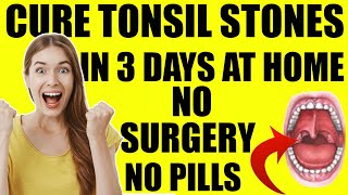 Tonsil Stones Treatment Removal At Home  Get Rid Of Tonsil Stones In JUST 3 Days FOREVER [upl. by Eppie]