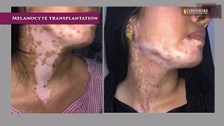 Melanocyte Transplantation  Vitiligo  Leukoderma Treatment  Dr Venkata Ramana Yamani  Contours [upl. by Leirrad]