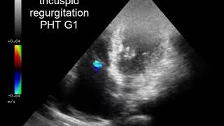 case 542 ECHO mild mitral regurgitation TR PHT G1 [upl. by Attem]