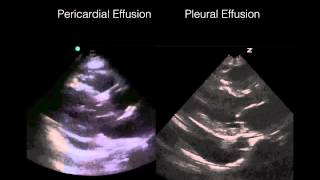 How to Interpret a Chest XRay Lesson 6  Diaphragm and Pleura [upl. by Perpetua]