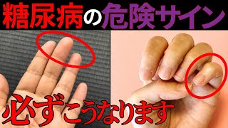 【医師監修】絶対に見逃してはいけない「糖尿病の手からの危険サイン」症状から予防法まで徹底解説 [upl. by Otreblaug]