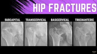 Hip Fractures and Treatment Methods Explainer with Xray examples [upl. by Lonyer]