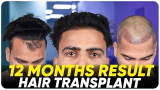 Hair Transplant in Abu Dhabi  Best Results amp Cost of Hair Transplant in Abu Dhabi [upl. by Nytsirt]