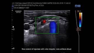 Ultrasound guided injection of C6 cervical root [upl. by Dumah]