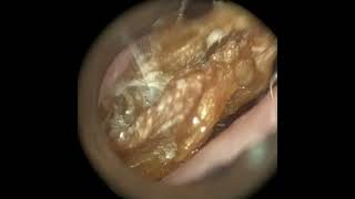 253  Complex Ear Wax amp Dead Skin Extraction from Narrow Ear using the WAXscope®️ [upl. by Cavill]