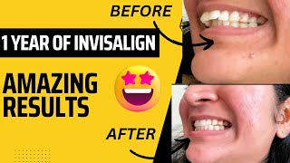 My Invisalign Journey  1 Year of INVISALIGN  Remarkable Progress in 1 Year [upl. by Aroon]