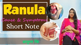 Ranula কী  plunging ranula  mucocele  treatment of RANULA  Etiology Clinical Features [upl. by Enelyad]