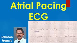 Atrial Pacing ECG [upl. by Ettenan]