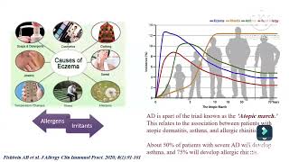 Atopic dermatitis diagnosis amp assessment Prof Ghada Shousha Pediatric immunology amp allergy Ain Shams [upl. by Enahsed546]