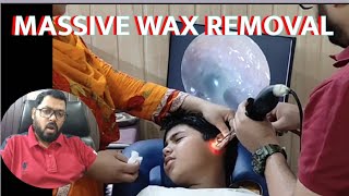 MASSIVE WAX CHAP 2ENDOSCOPIC EAR WAX [upl. by Akkeber]