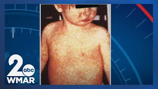 With national international measles upticks Hopkins Dr explains what to know [upl. by Johanna]