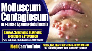 Molluscum Contagiosum in XLA  Causes And Treatment  Medicam [upl. by Telrats]