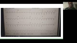 04 07 2024 Case Presentation Cirrhotic Patient for Right Hepatectomy [upl. by Atla]