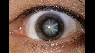 Eye Drops That Dissolve Cataracts [upl. by Rebbecca]