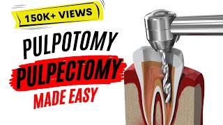 Pulpotomy and Pulpectomy  PEDIATRIC DENTISTRY [upl. by Vlada468]