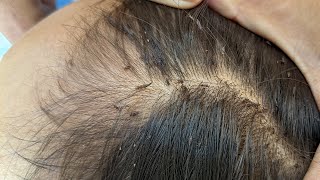 Remove many lice from brown hair  Plucking most of lice from head [upl. by Enitsenre713]