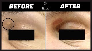 Remove Xanthelasma from Eye Lids  Before amp After Photos  ICLS Dermatology amp Plastic Surgery [upl. by Allegna]