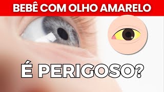 olho amarelo ou icterícia é perigoso Pprecisa fazer BANHO DE LUZ [upl. by Hakym]