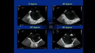 3DTEE imaging for ASD closure [upl. by Yeslek]