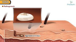 Scabies Predisposing factors Pathogenesis Types Clinical features Diagnosis Treatment [upl. by Rosenberg]