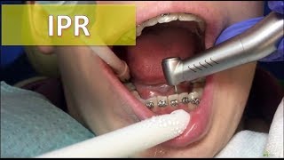 Interproximal reduction  IPR [upl. by Duck]