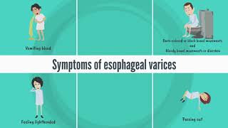 Patient education Esophageal varices The Basics [upl. by Ilrebmyk]