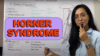 HORNER syndrome [upl. by Ailgna]