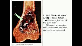 Giant cell tumor of bone and Metastatic disease [upl. by Aiuqat]