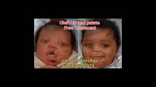 CLEFT LIP AND PALATE TREATMENT FREE IN SILIGURI shorts cleftsurgery cleftpalate [upl. by Marih159]