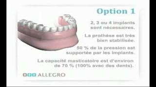 Implants dentaires  Prothèse sur piliers boules [upl. by Ynos]