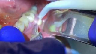 Draining a Dental Abscess  Advanced Dental Care [upl. by Jollenta]