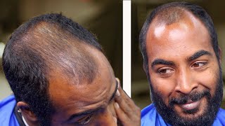 WARNING  A Solution to GOING BALD 💯 His Wife did not recognize him [upl. by Leisam863]